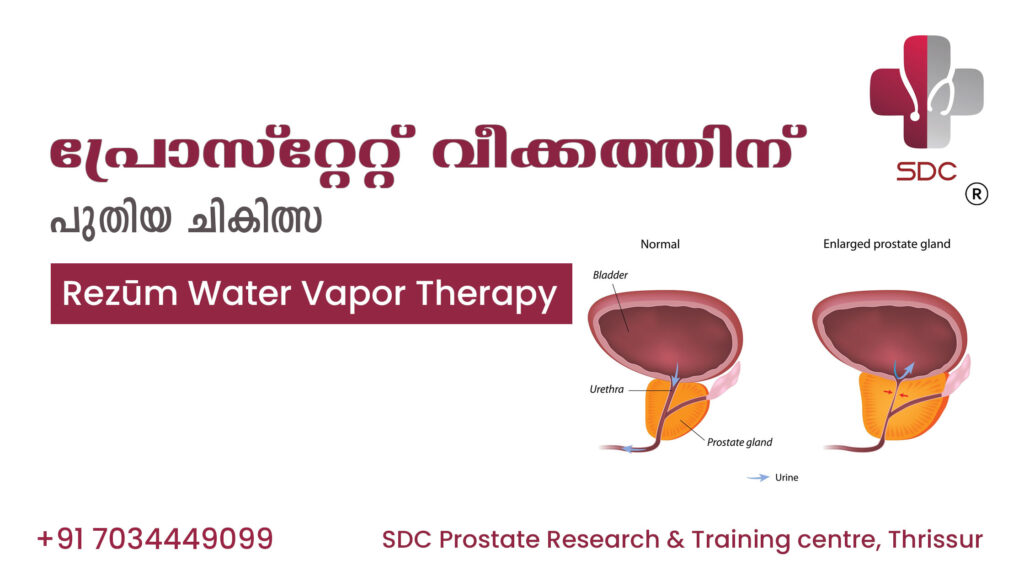 Patient undergoing Rezūm Water Vapor Therapy, a minimally invasive treatment for prostate inflammation at SDC Prostate Research Centre.