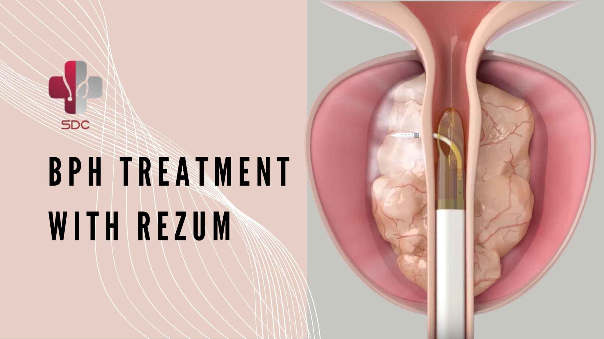 BPH Treatment: Understanding and Managing Benign Prostatic Hyperplasia ...