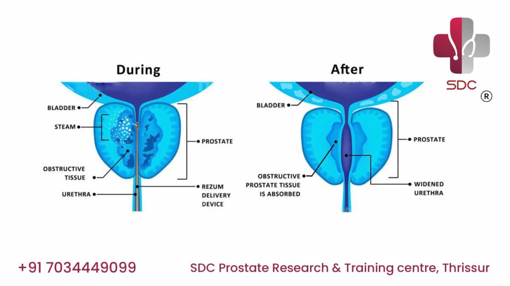 Doctor explaining Rezūm Water Vapor Therapy for benign prostatic hyperplasia (BPH) treatment to a patient at SDC Prostate Research & Training Centre