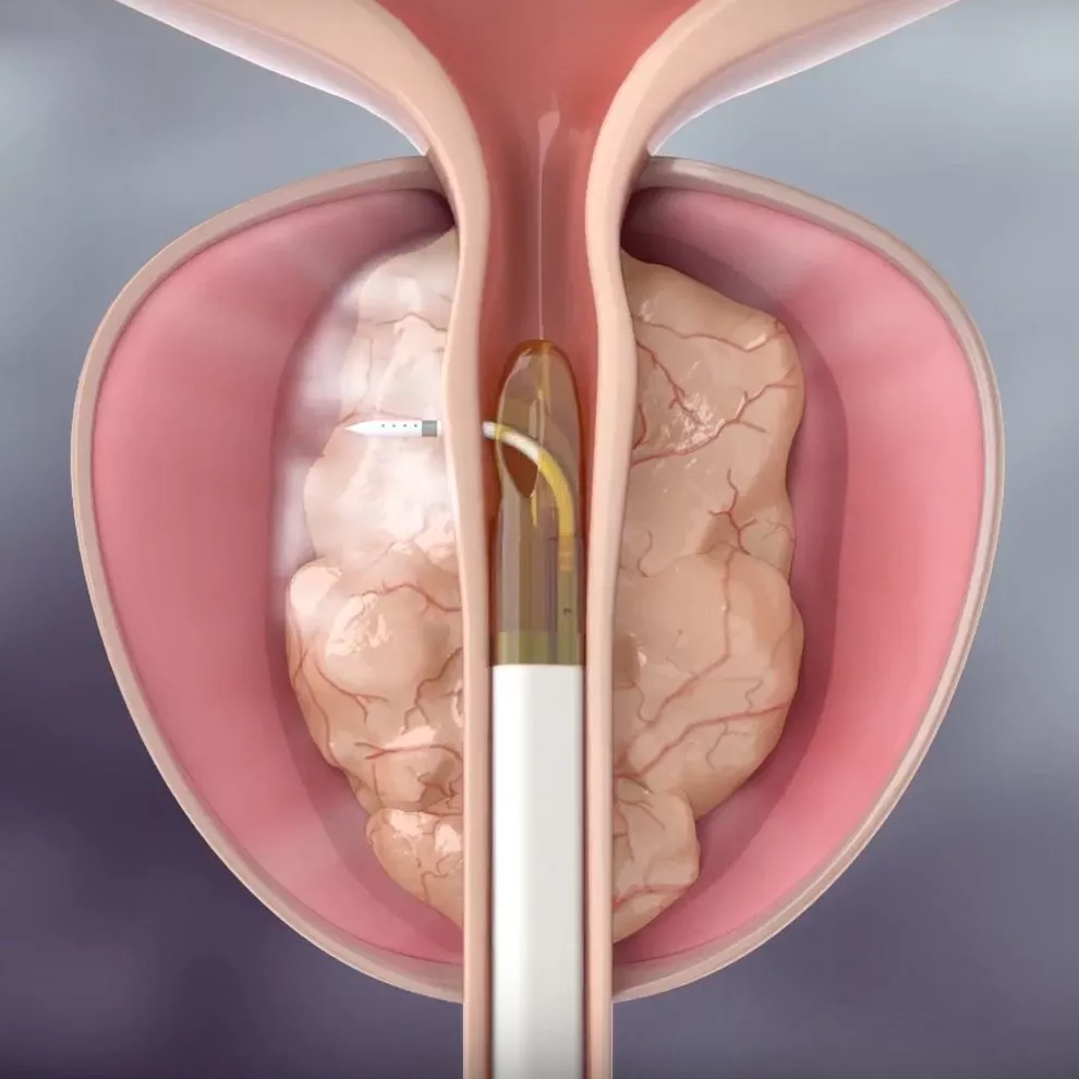 Visual representation of the Rezum water vapor therapy process for prostate treatment.