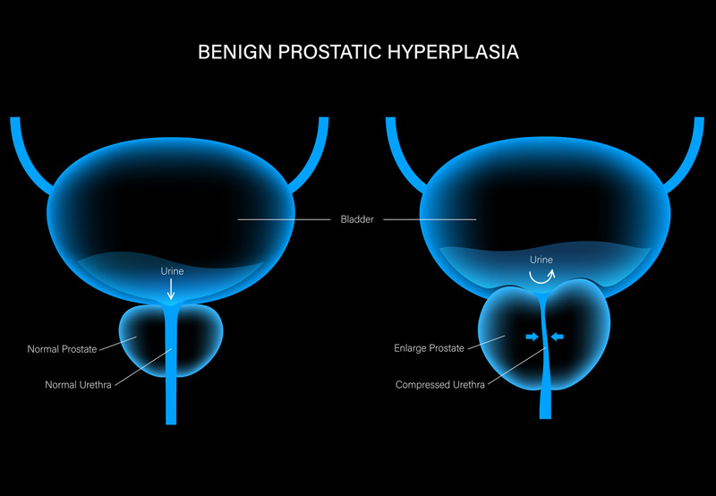 Illustration depicting the enlarged prostate gland associated with benign prostatic hyperplasia, highlighting its impact on urinary function.