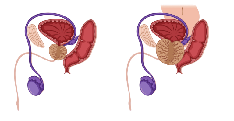 Diagram explaining prostatic hyperplasia, depicting an enlarged prostate and associated urinary symptoms.