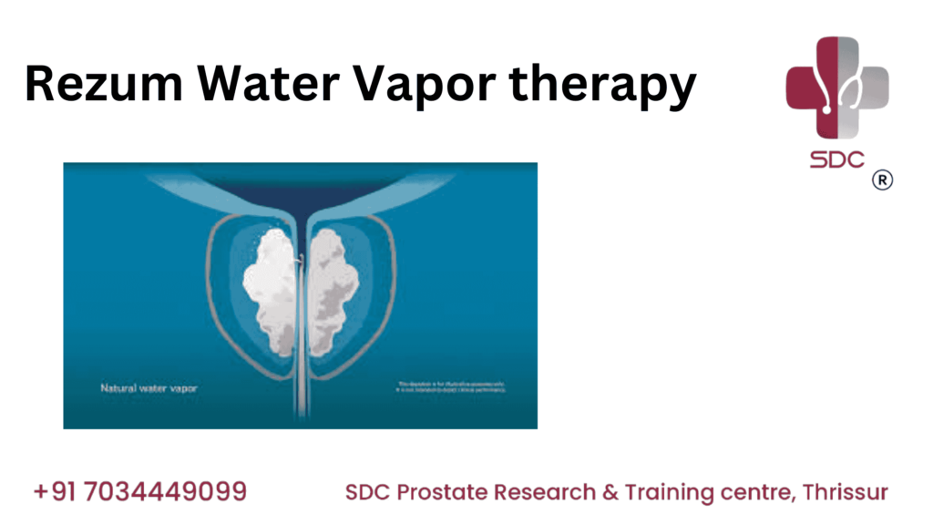 Rezum Water Vapor Therapy procedure illustration showing how steam reduces excess prostate tissue to relieve BPH symptoms