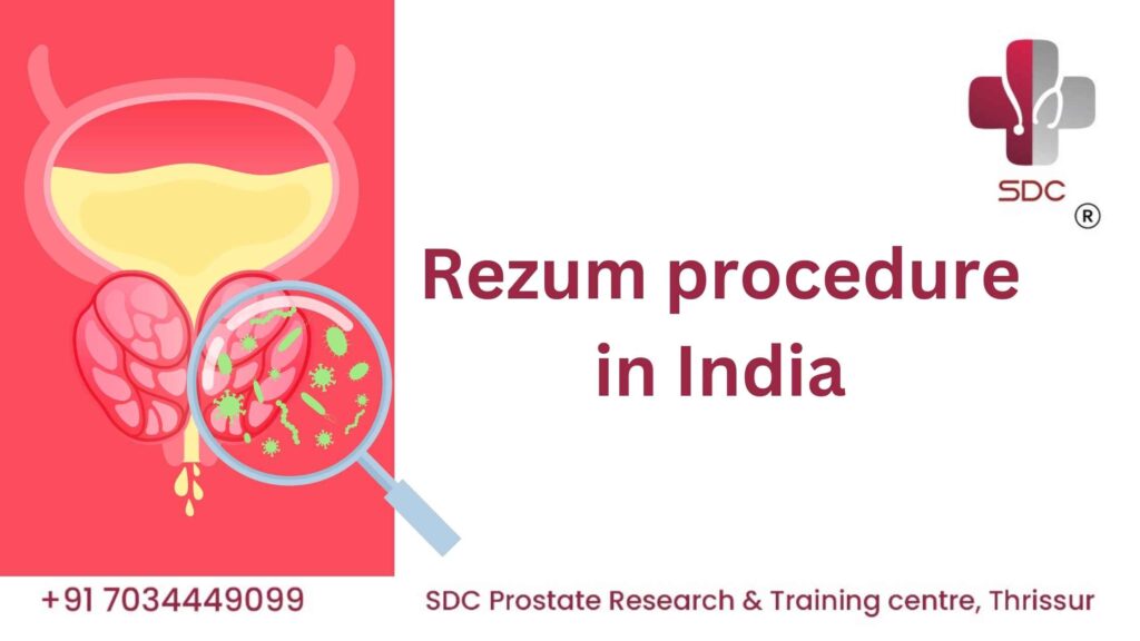 Modern treatment for BPH using Rezum Water Vapor Therapy, available at SDC Prostate Research Centre in Thrissur, Kerala