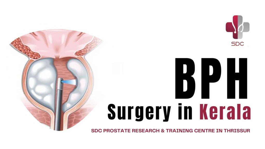 BPH Surgery in Kerala at SDC Prostate Research & Training Centre