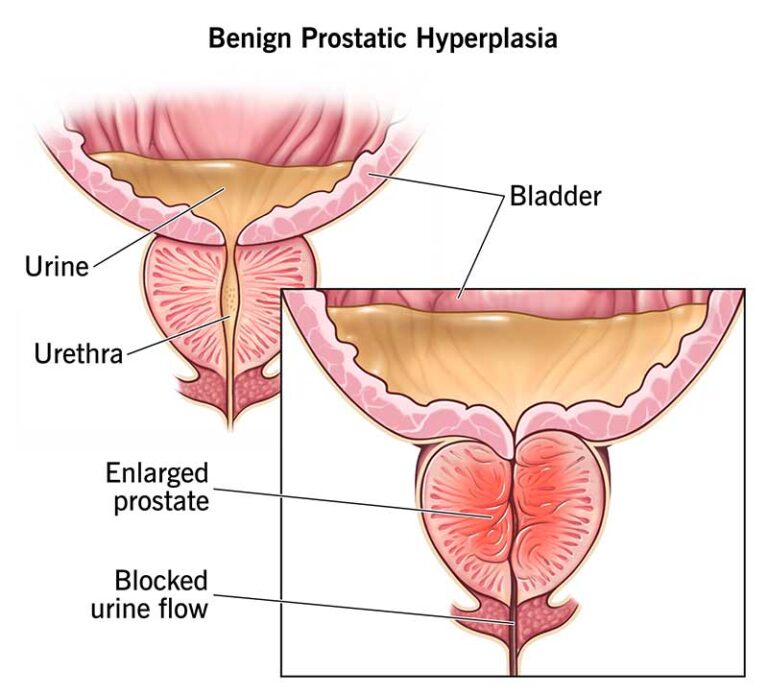Best Prostate Enlargement Treatment Hospital in Kerala