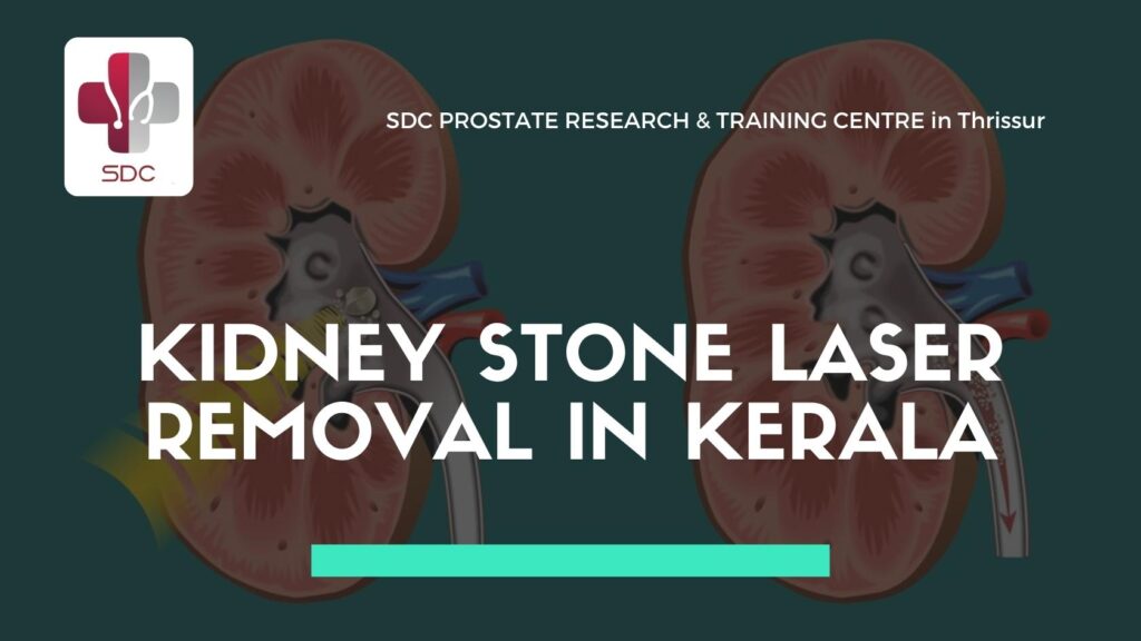Doctor performing laser lithotripsy for kidney stone removal at SDC Prostate Research & Training Centre